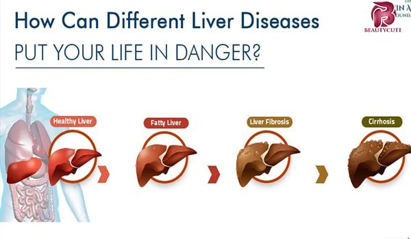 بیماری های کبد